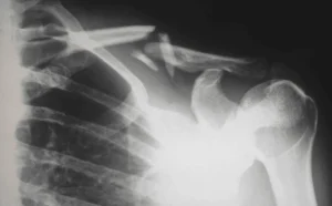 Five Types of Catastrophic Injuries Caused by Car Accidents