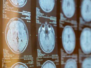 What Should I Do After a Traumatic Brain Injury?